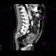 Lymphoma of small bowel, ileum: CT - Computed tomography